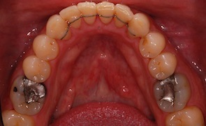 Invisalign