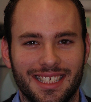 Invisalign