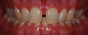 Invisalign