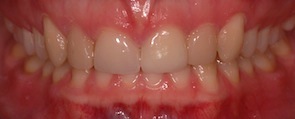 Invisalign