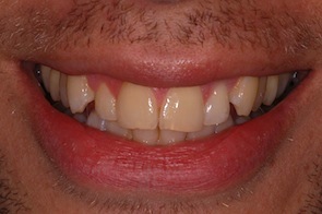 Invisalign