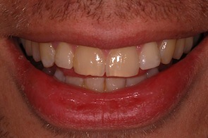 Invisalign