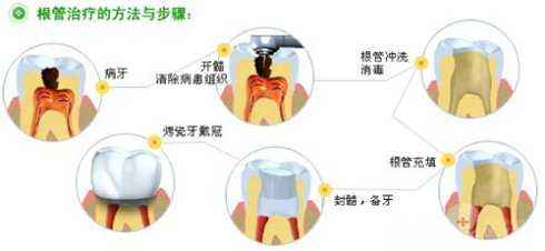 根管治疗的一般操作步骤