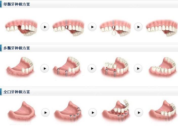 牙齿修复方案