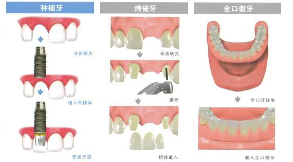 牙齿修复价格