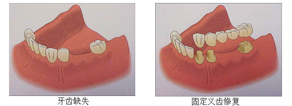 牙齿修复方案