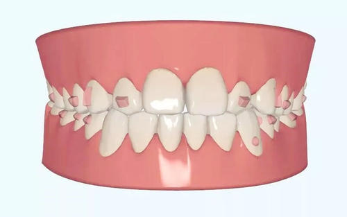 牙齿修复方案