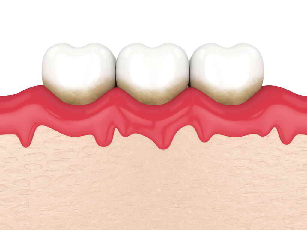 牙龈出血原因,流牙血原因