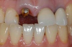 镶牙前口腔内的残根如何处理？