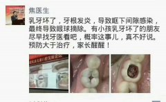 4岁男孩牙坏后，摘了一个眼！关于乳牙的这些误