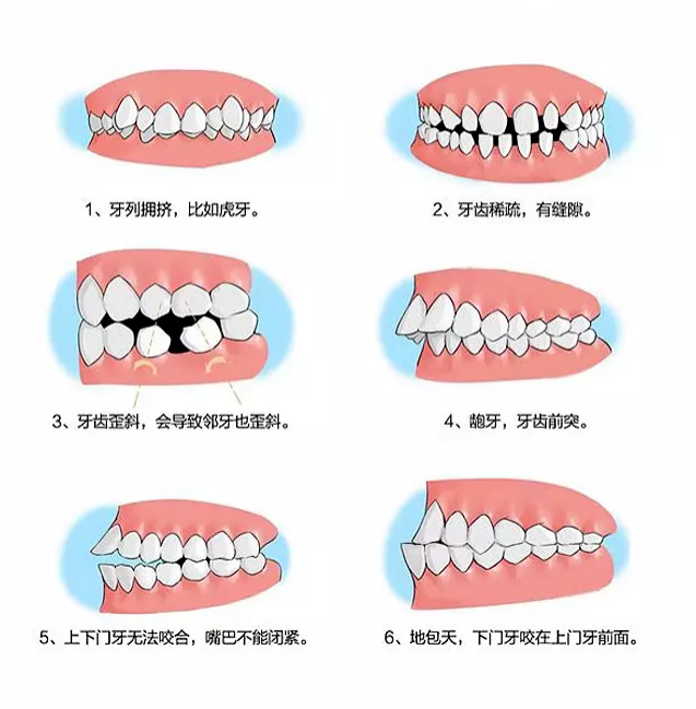矫正牙齿时间