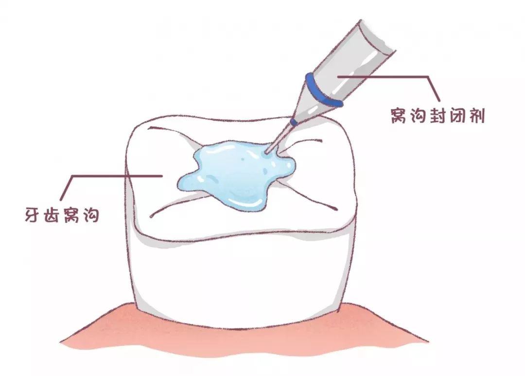 窝沟封闭
