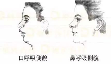 不良口腔习惯