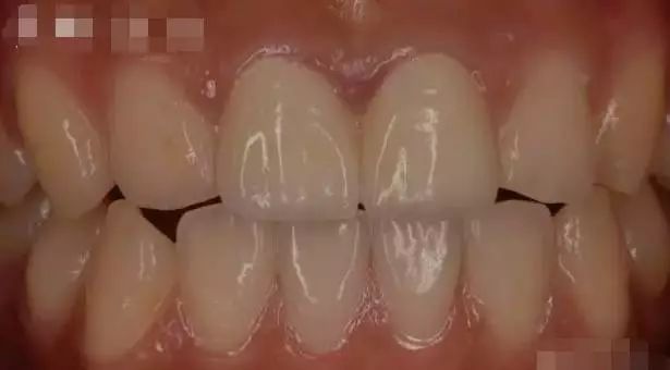 氧化锆全瓷牙