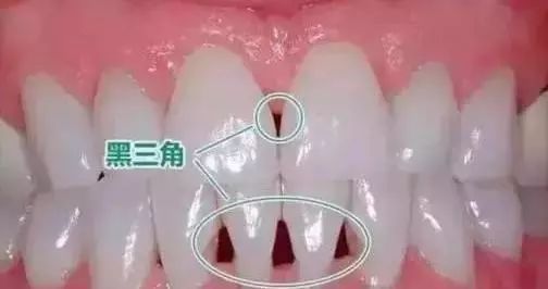 牙齿黑三角