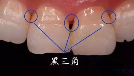 牙齿黑三角