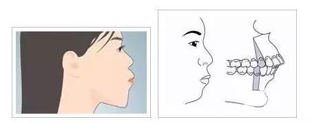等待种植牙的时间能再短点吗