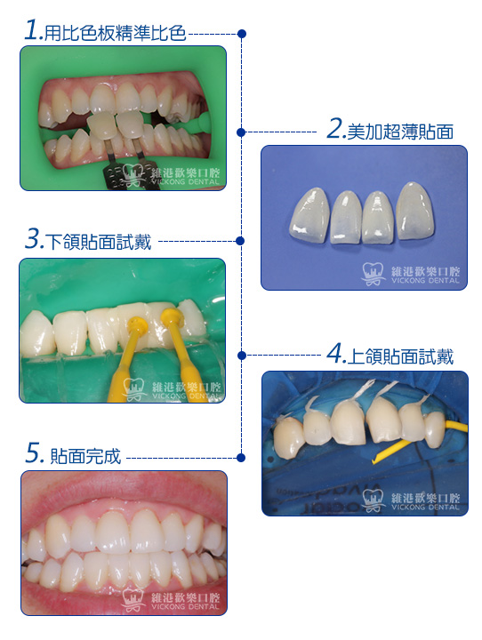 维港口腔连锁品牌瓷牙贴面的美学技术优势