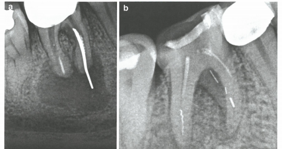 牙齿根管内显微镜下取断针-根管内分离器械处理